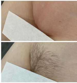 Шугаринг эпиляция