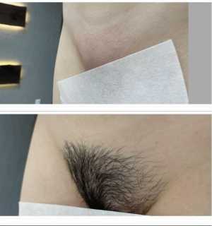 Шугаринг эпиляция