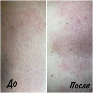 Электроэпиляция