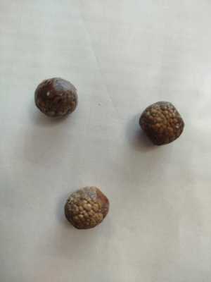 Камни из желчного пузыря