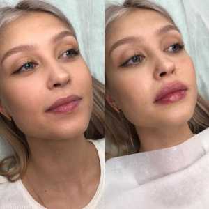 Увеличение губ
