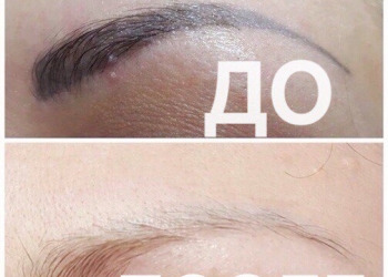 Лазерное удаление тату, сведение татуажа