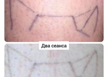 Удаление лазером тату и татуаж, карбоновый пилинг