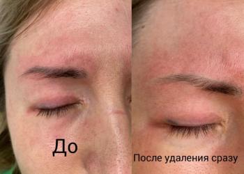 Удаление лазером тату и татуаж, карбоновый пилинг